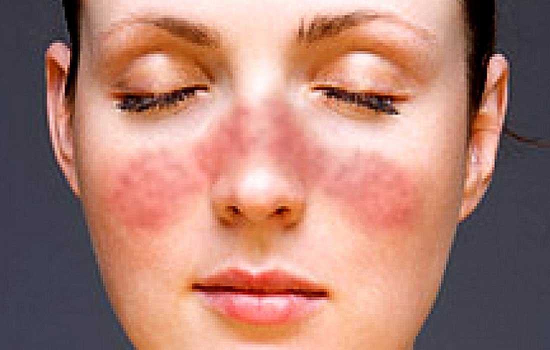 Lupus