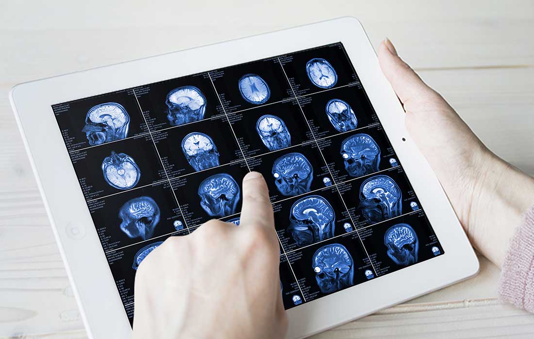 Multiple Sclerosis